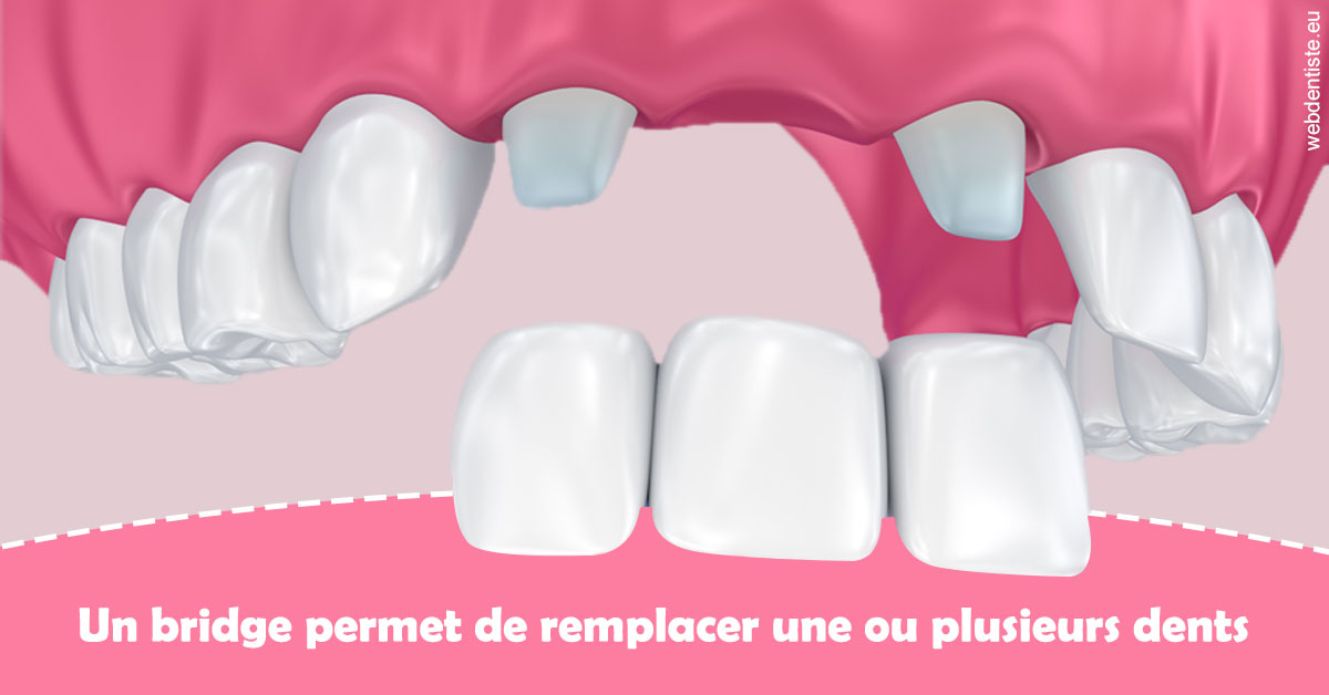 https://selarl-d-arguin.chirurgiens-dentistes.fr/Bridge remplacer dents 2