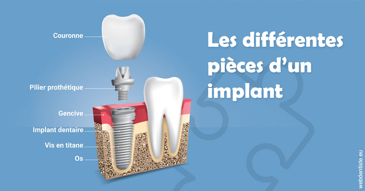 https://selarl-d-arguin.chirurgiens-dentistes.fr/Les différentes pièces d’un implant 1